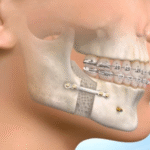 Understanding Jaw Surgery: What It Is, Why It’s Done, and What to Expect