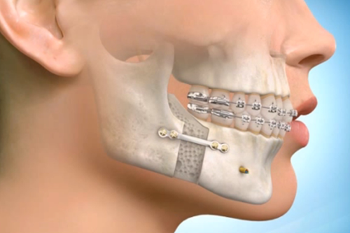 Understanding Jaw Surgery: What It Is, Why It’s Done, and What to Expect